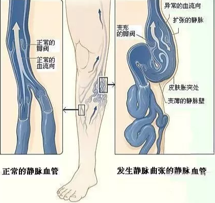 最新静脉曲张疗法概述与解读